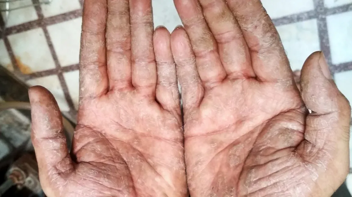 Vipadikahara Ghrita–Taila: a classical Ayurvedic formulation for palmo-plantar psoriasis